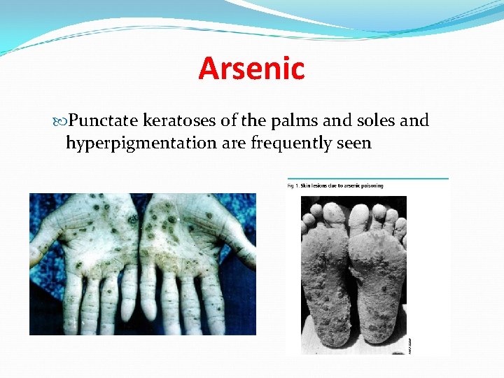 Arsenic Punctate keratoses of the palms and soles and hyperpigmentation are frequently seen 