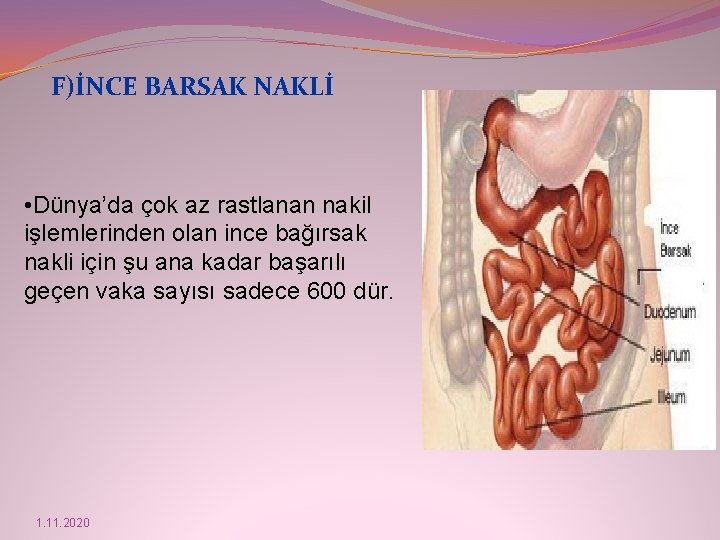 F)İNCE BARSAK NAKLİ • Dünya’da çok az rastlanan nakil işlemlerinden olan ince bağırsak nakli