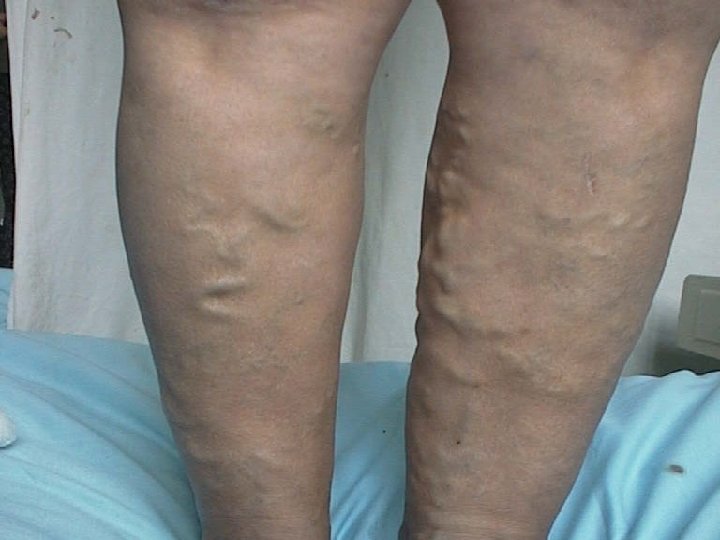 bandaj de congestionare pe genunchi cu varicoza