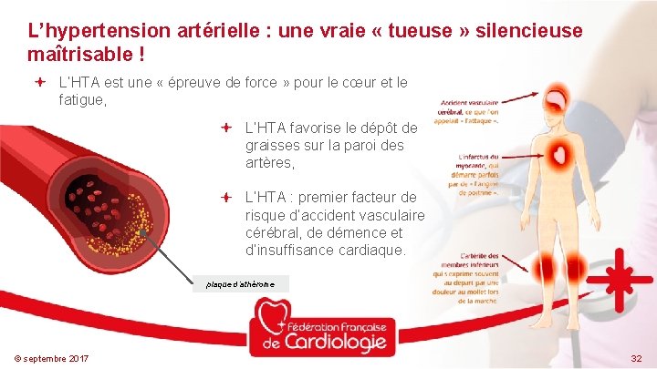 L’hypertension artérielle : une vraie « tueuse » silencieuse maîtrisable ! L’HTA est une