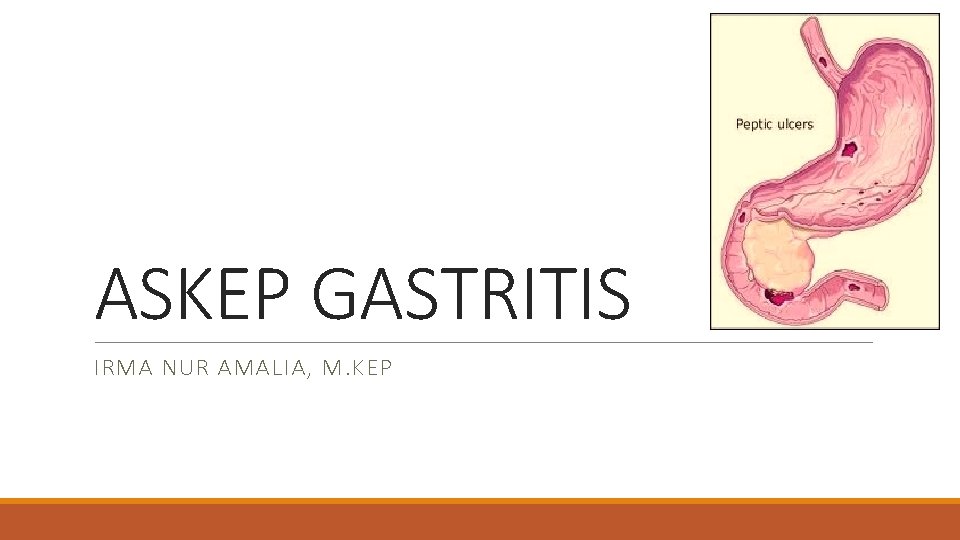 ASKEP GASTRITIS IRMA NUR AMALIA, M. KEP 