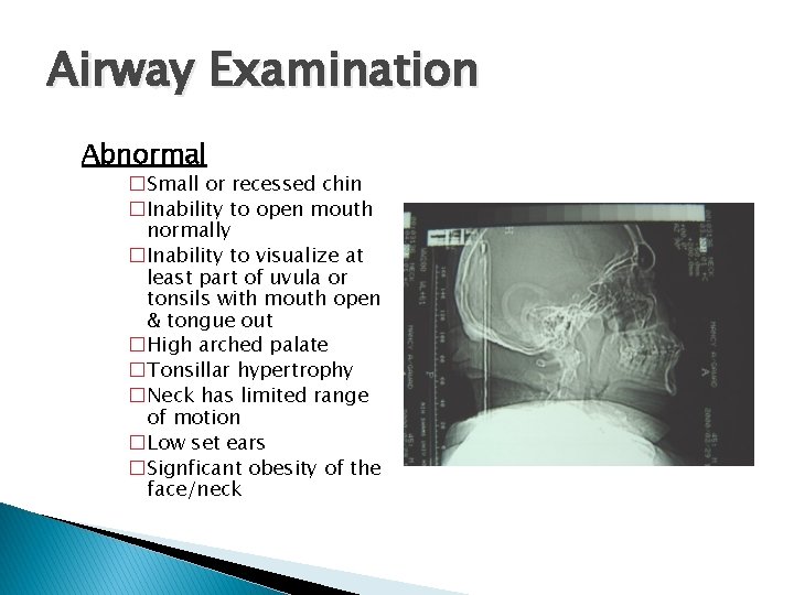 Airway Examination Abnormal �Small or recessed chin �Inability to open mouth normally �Inability to