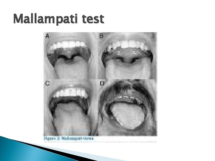 Mallampati test 