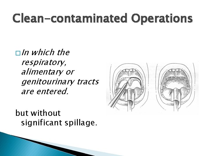 Clean-contaminated Operations � In which the respiratory, alimentary or genitourinary tracts are entered. but