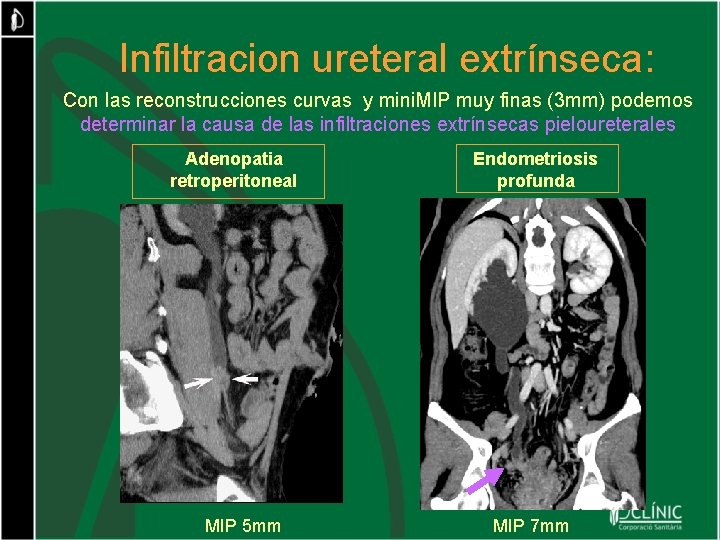 Infiltracion ureteral extrínseca: Con las reconstrucciones curvas y mini. MIP muy finas (3 mm)