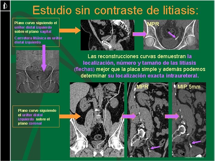 Estudio sin contraste de litiasis: Plano curvo siguiendo el uréter distal izquierdo sobre el