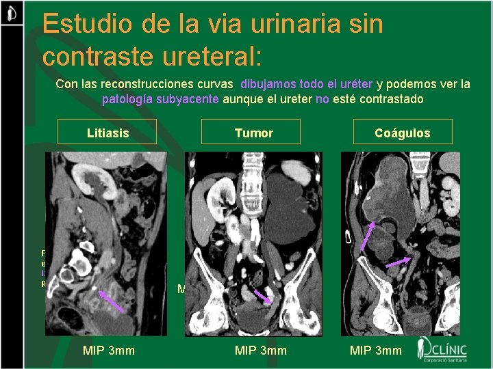 Estudio de la via urinaria sin contraste ureteral: Con las reconstrucciones curvas dibujamos todo