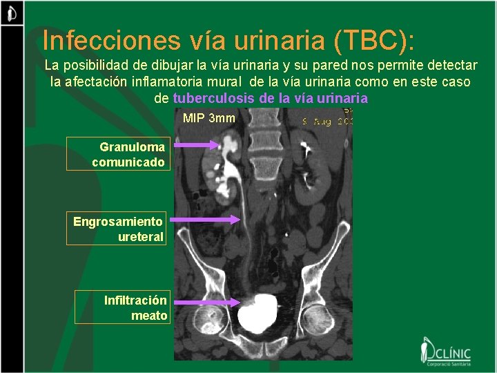 Infecciones vía urinaria (TBC): La posibilidad de dibujar la vía urinaria y su pared