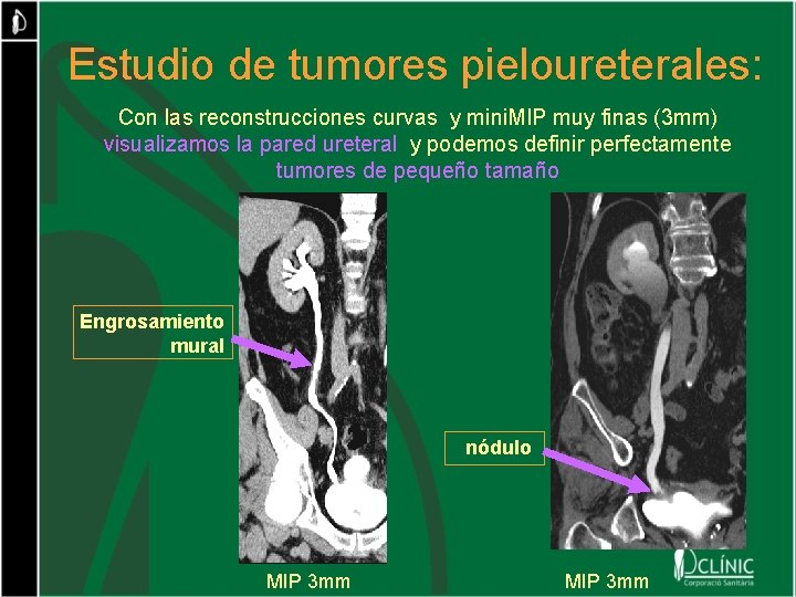 Estudio de tumores pieloureterales: Con las reconstrucciones curvas y mini. MIP muy finas (3