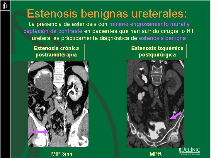 Estenosis benignas ureterales: La presencia de estenosis con mínimo engrosamiento mural y captación de