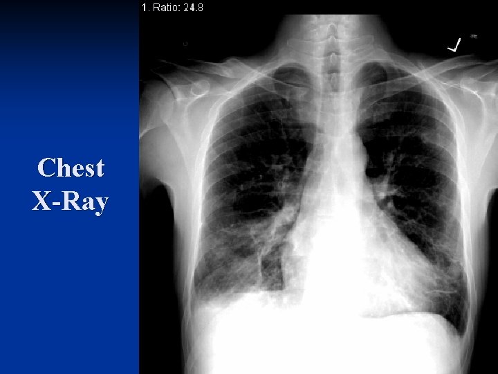 Chest X-Ray Chest X-Ray