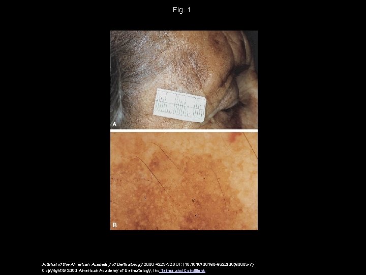 Fig. 1 Journal of the American Academy of Dermatology 2000 4225 -32 DOI: (10.