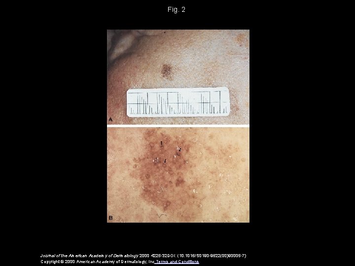 Fig. 2 Journal of the American Academy of Dermatology 2000 4225 -32 DOI: (10.