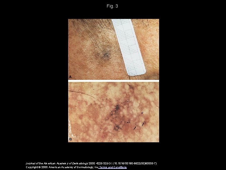 Fig. 3 Journal of the American Academy of Dermatology 2000 4225 -32 DOI: (10.