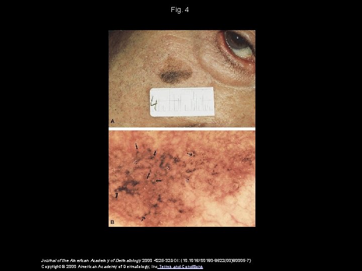 Fig. 4 Journal of the American Academy of Dermatology 2000 4225 -32 DOI: (10.
