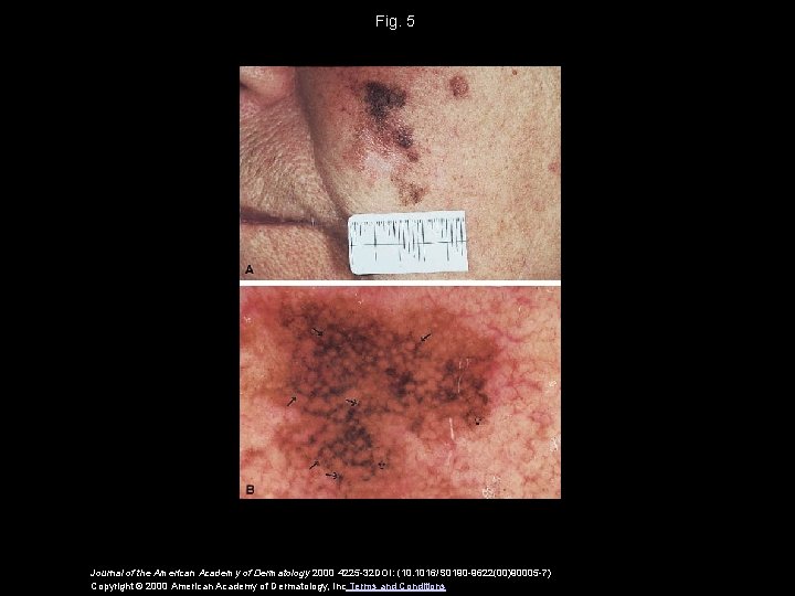 Fig. 5 Journal of the American Academy of Dermatology 2000 4225 -32 DOI: (10.