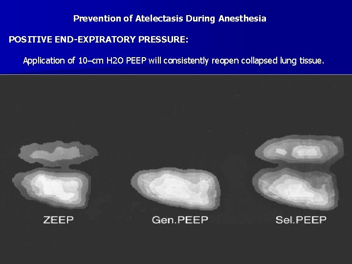 Prevention of Atelectasis During Anesthesia POSITIVE END-EXPIRATORY PRESSURE: Application of 10–cm H 2 O