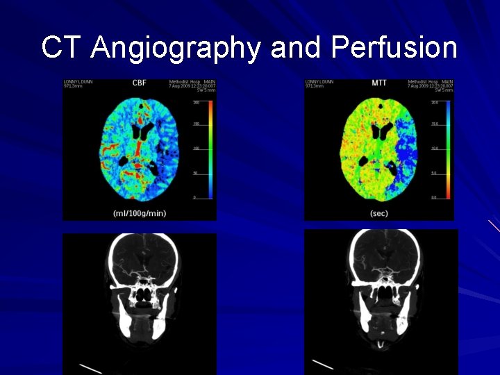 CT Angiography and Perfusion CT Angiography and Perfusion