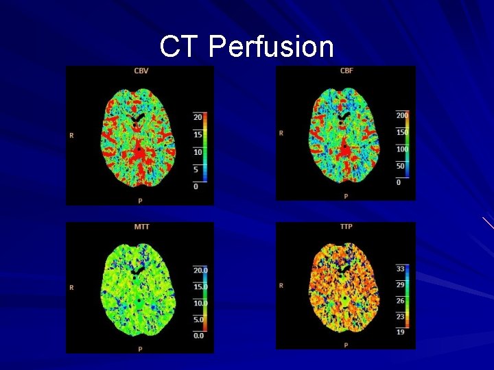 CT Perfusion CT Perfusion