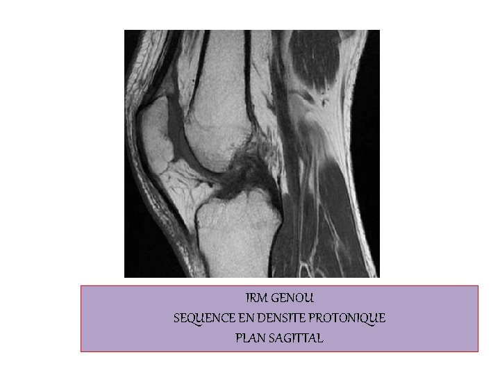 IRM GENOU SEQUENCE EN DENSITE PROTONIQUE PLAN SAGITTAL 