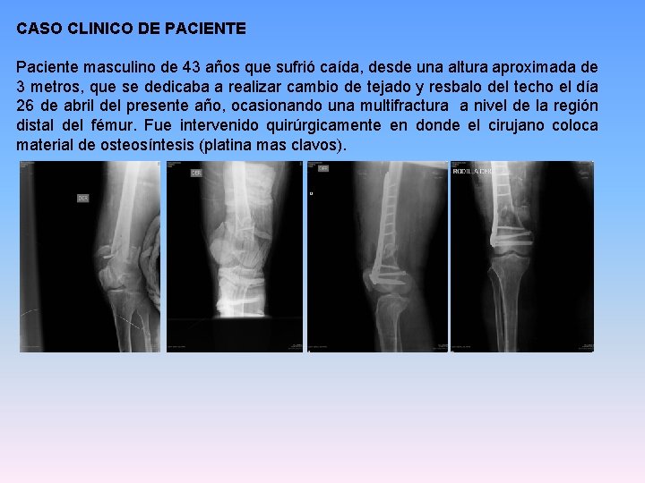CASO CLINICO DE PACIENTE Paciente masculino de 43 años que sufrió caída, desde una CASO CLINICO DE PACIENTE Paciente masculino de 43 años que sufrió caída, desde una