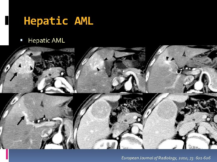 Hepatic AML European Journal of Radiology, 2010; 73: 601 -606 Hepatic AML European Journal of Radiology, 2010; 73: 601 -606