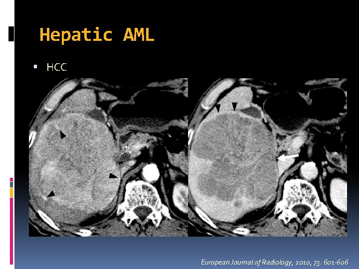 Hepatic AML HCC European Journal of Radiology, 2010; 73: 601 -606 Hepatic AML HCC European Journal of Radiology, 2010; 73: 601 -606