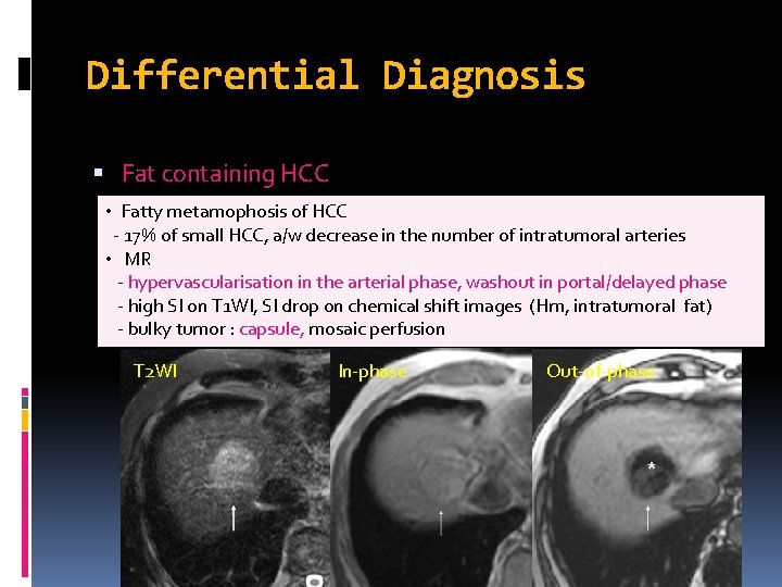 Differential Diagnosis Fat containing HCC • Fatty metamophosis of HCC - 17% of small Differential Diagnosis Fat containing HCC • Fatty metamophosis of HCC - 17% of small