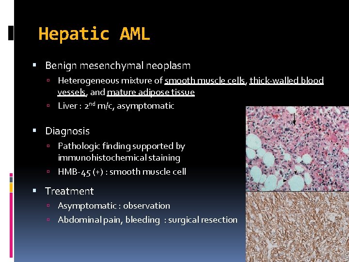 Hepatic AML Benign mesenchymal neoplasm Heterogeneous mixture of smooth muscle cells, thick-walled blood vessels, Hepatic AML Benign mesenchymal neoplasm Heterogeneous mixture of smooth muscle cells, thick-walled blood vessels,