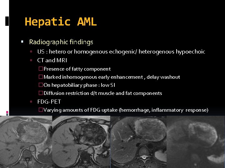 Hepatic AML Radiographic findings US : hetero or homogenous echogenic/ heterogenous hypoechoic CT and Hepatic AML Radiographic findings US : hetero or homogenous echogenic/ heterogenous hypoechoic CT and