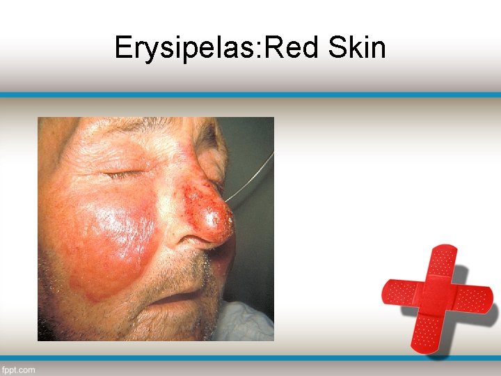 Erysipelas: Red Skin 