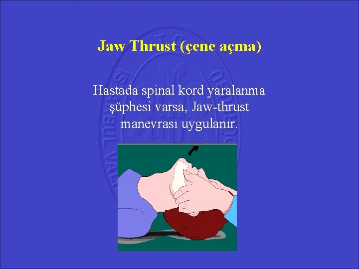 Jaw Thrust (çene açma) Hastada spinal kord yaralanma şüphesi varsa, Jaw-thrust manevrası uygulanır. Jaw Thrust (çene açma) Hastada spinal kord yaralanma şüphesi varsa, Jaw-thrust manevrası uygulanır.