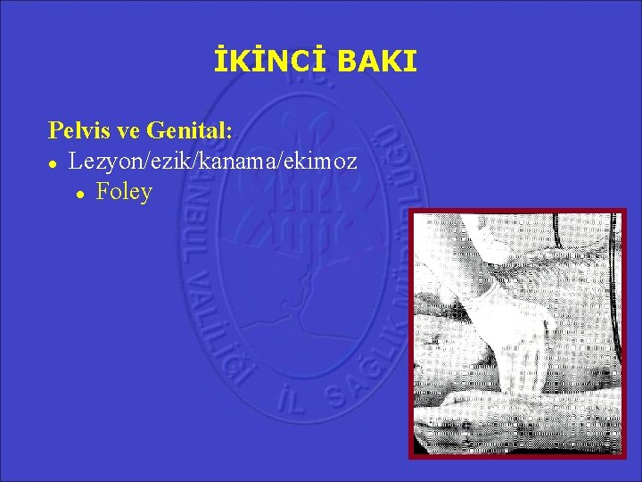 İKİNCİ BAKI Pelvis ve Genital: Lezyon/ezik/kanama/ekimoz Foley 