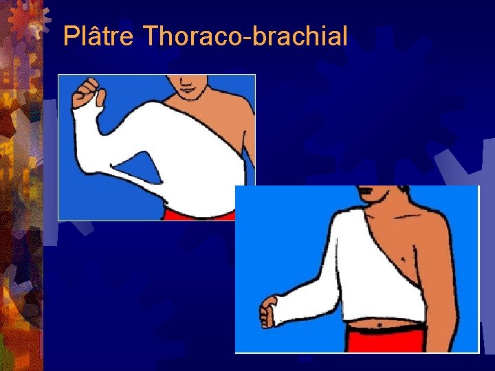 Plâtre Thoraco-brachial 