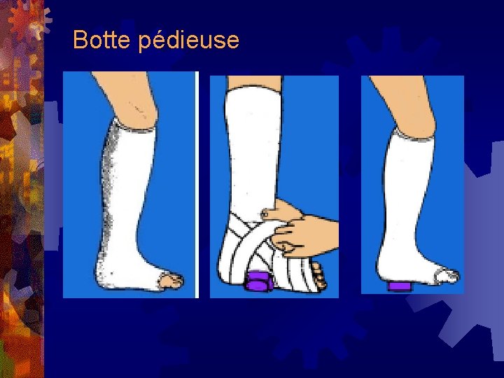 Botte pédieuse 