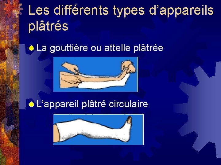 Les différents types d’appareils plâtrés ® La gouttière ou attelle plâtrée ® L’appareil plâtré