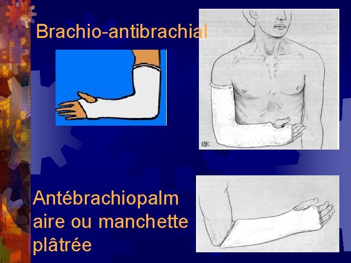 Brachio-antibrachial Antébrachiopalm aire ou manchette plâtrée 