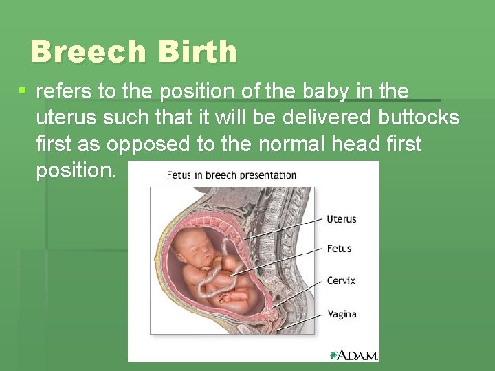 Breech Birth § refers to the position of the baby in the uterus such Breech Birth § refers to the position of the baby in the uterus such