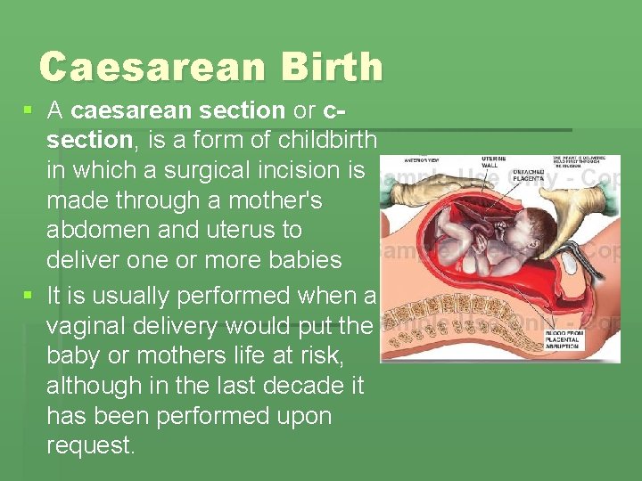 Caesarean Birth § A caesarean section or csection, is a form of childbirth in Caesarean Birth § A caesarean section or csection, is a form of childbirth in