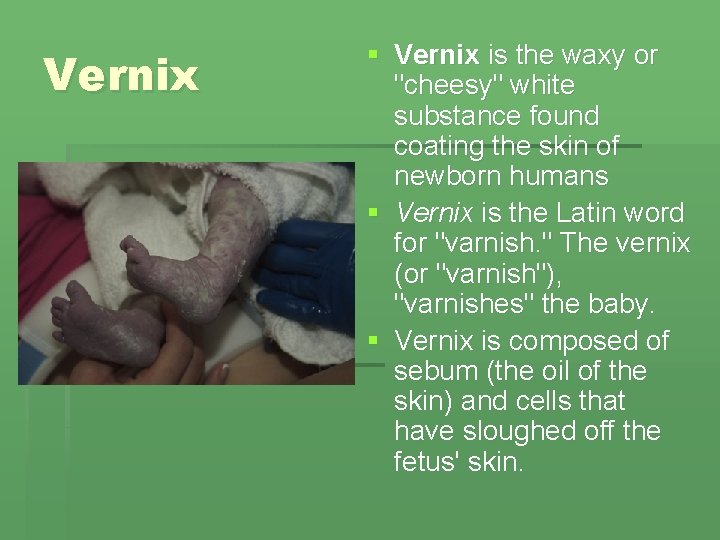 Vernix § Vernix is the waxy or "cheesy" white substance found coating the skin Vernix § Vernix is the waxy or "cheesy" white substance found coating the skin