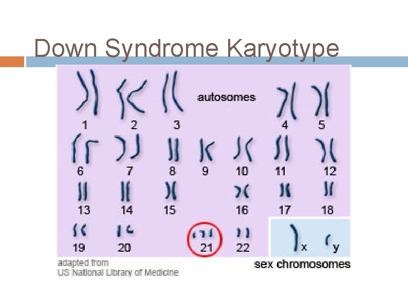 Down Syndrome Karyotype 