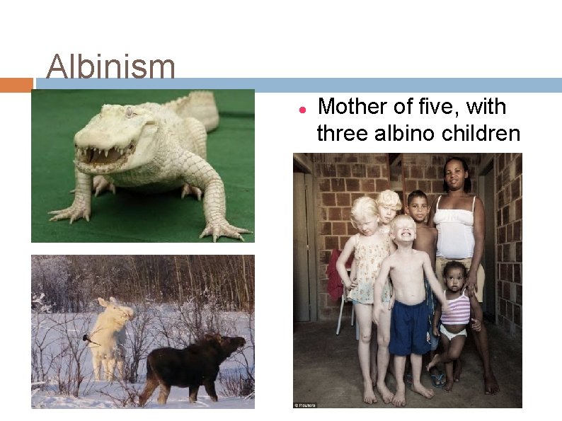 Albinism Mother of five, with three albino children 