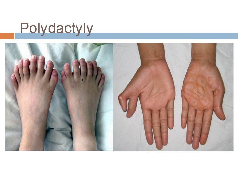 Polydactyly 