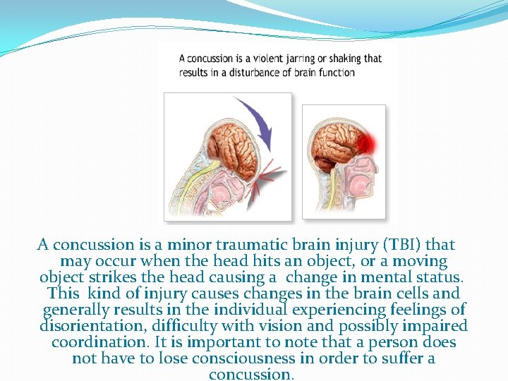 A concussion is a minor traumatic brain injury (TBI) that may occur when the