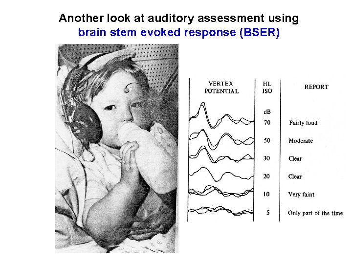 Another look at auditory assessment using brain stem evoked response (BSER) 