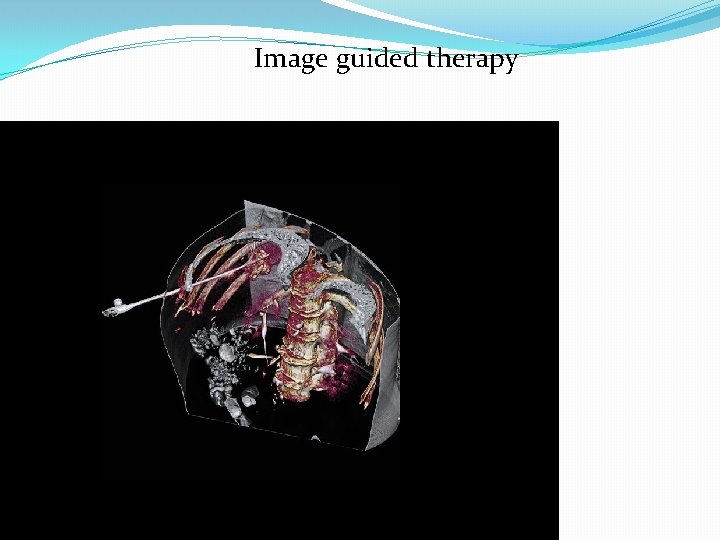 Image guided therapy 