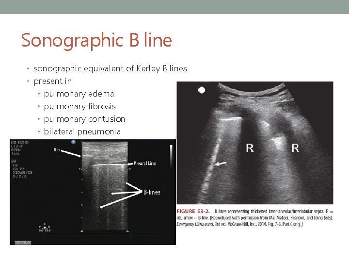 Sonographic B line • sonographic equivalent of Kerley B lines • present in •
