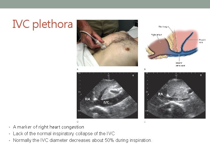 IVC plethora • A marker of right heart congestion • Lack of the normal