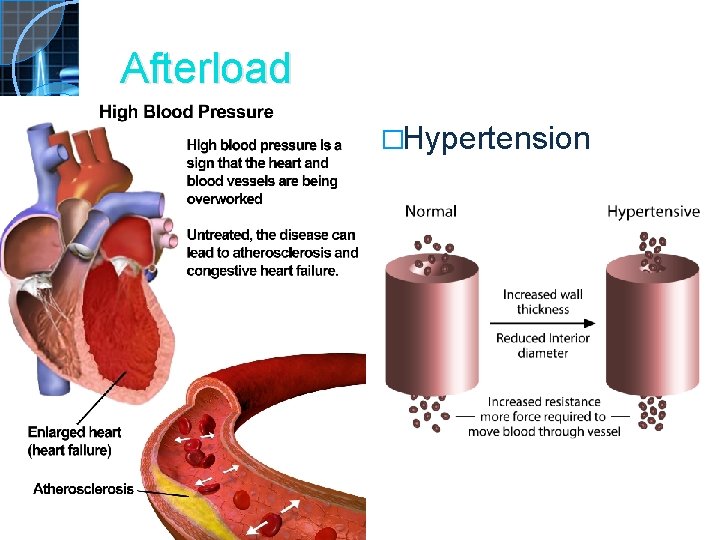 Afterload �Hypertension 