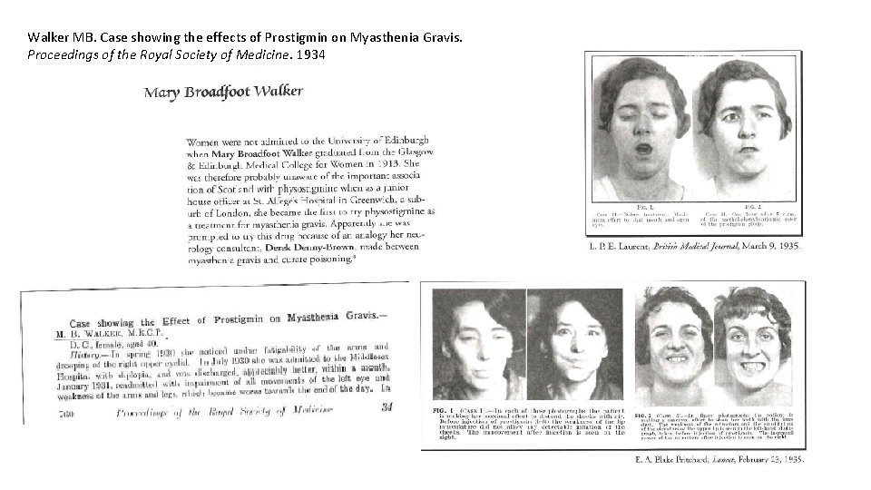 Walker MB. Case showing the effects of Prostigmin on Myasthenia Gravis. Proceedings of the